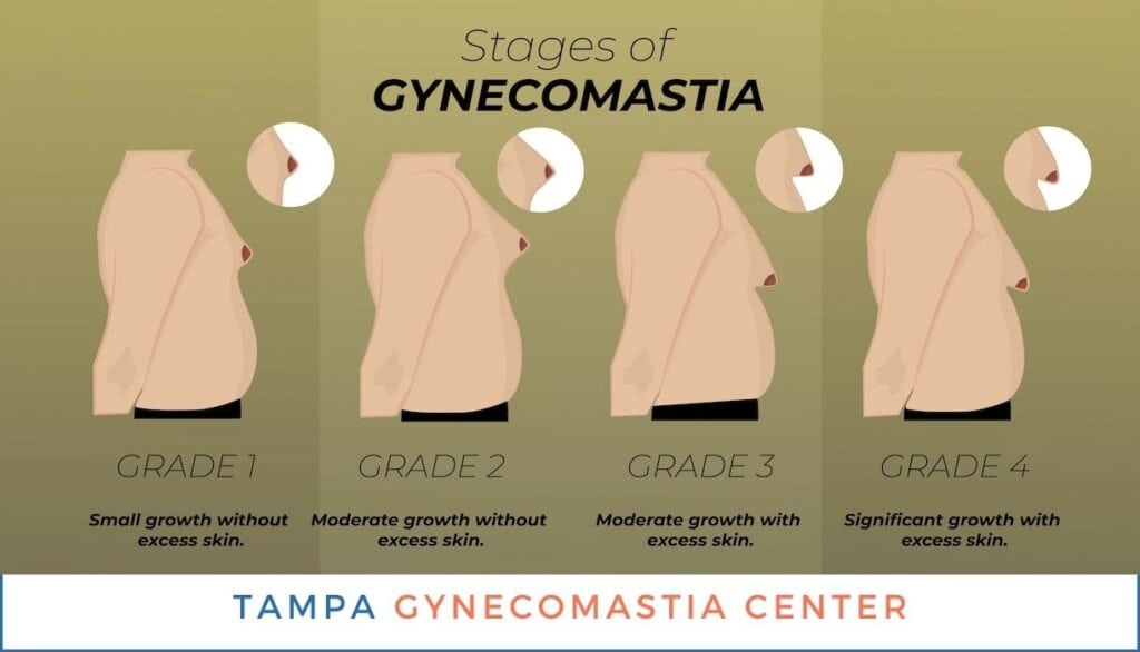 Stages and Grades of Gynecomastia